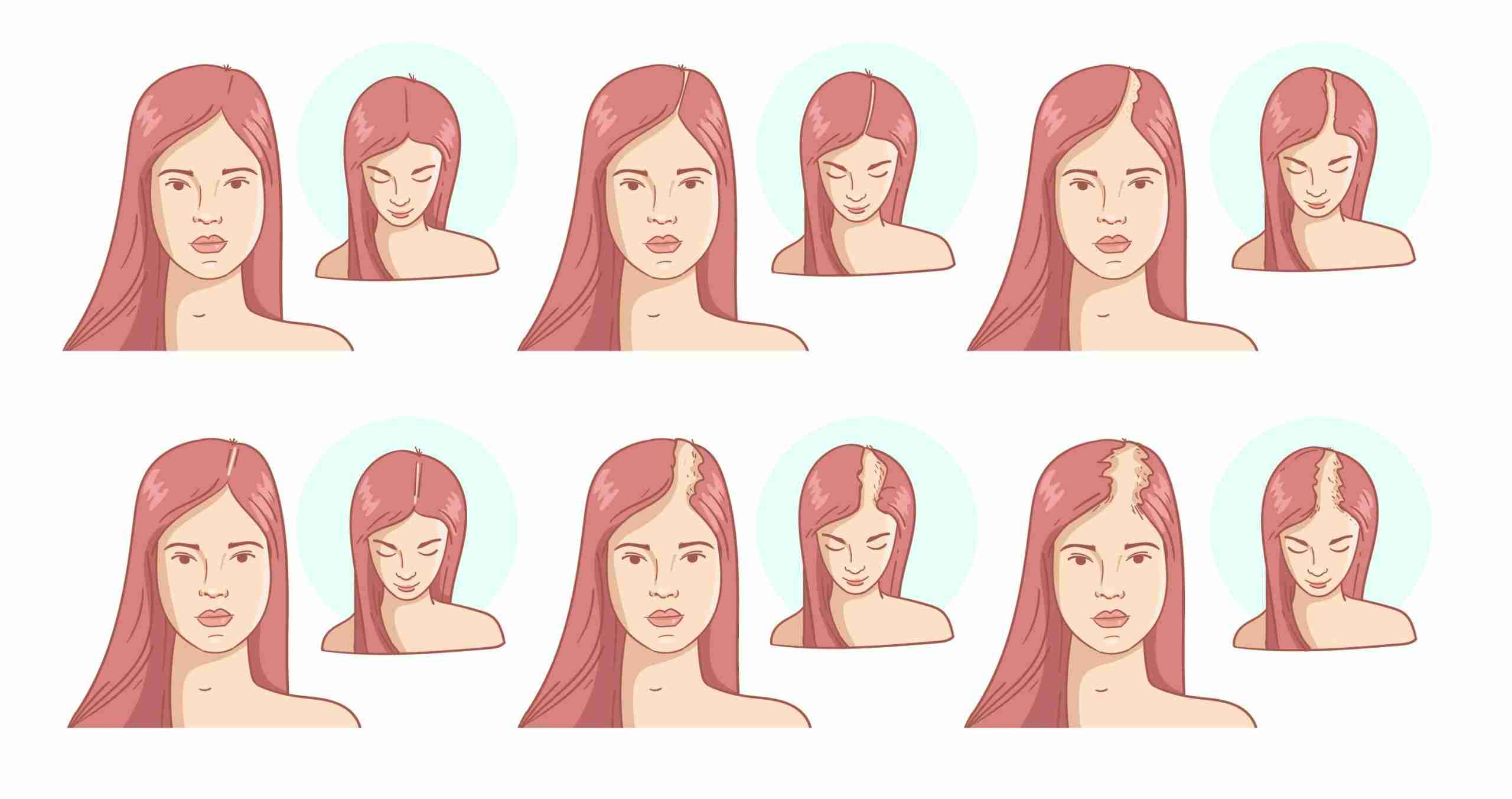 illustration showing female pattern baldness