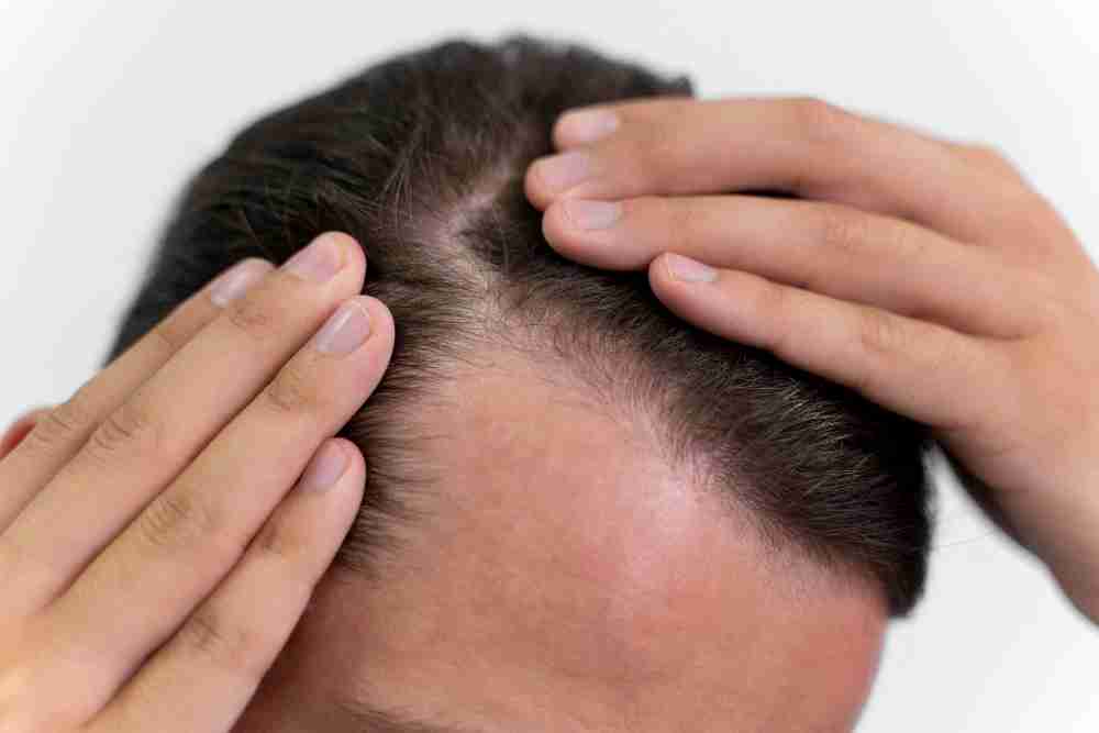 Man noticing his thinning hairline